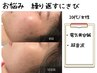 ＊6月からスタート!!【繰り返す肌荒れケア】肌荒れ撃退/美容鍼(70本)　