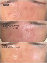 マヴィ 香里園店(MavY.)/ニキビケアお肌改善へ