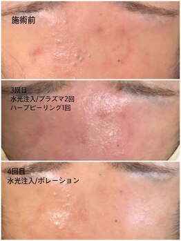 マヴィ 香里園店(MavY.)/ニキビケアお肌改善へ