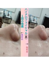 縁(en)/ハイドロフェイシャル