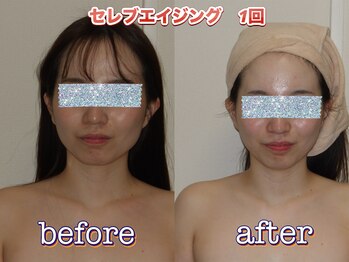 ボディグロス 梅田店(BODY GLOSS)/セレブエイジング1回