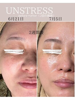 シンスプラス(SINCE+)/乳酸菌ピーリング、敏感肌、乾燥