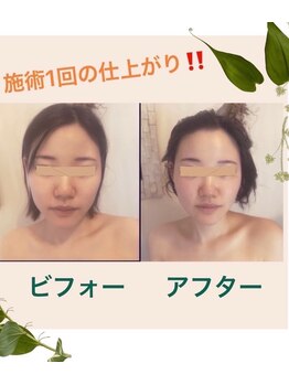 ネイチャー 新高円寺店(nature.)/別人級★小顔フェイシャル