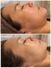 フルールドリス(FLEUR DE LIS)/韓国肌管理／ララピーリング☆