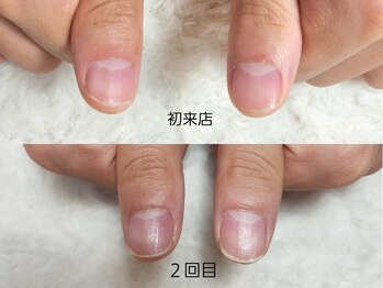 グラシナ なんば店/深爪/自爪育成/フィルイン