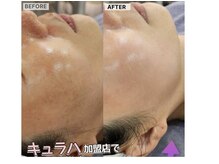 パールブルー(All Perl blue)/韓国特許取得の本格的エステ