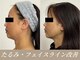 ソルニコン(Solnikon)の写真/小顔は骨格や筋肉から整える。看護師の小顔術で口元/輪郭を引き上げ、-10歳の若見え♪［小顔/たるみ/エラ］
