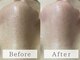 ルミラポー(Lumira Peau)の写真/【導入記念】最新マシンを使用して毛穴すっきりを目指す新メニューが7月末まで限定価格で体験できます。