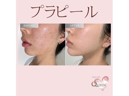 クイーン(QUEEN)の写真