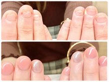 オー 町田モディ店(Oh!)/【スカルプ】深爪矯正　春に◎