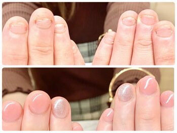 【スカルプ】深爪矯正　春に◎