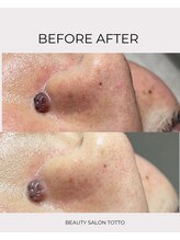 トット 恵比寿(totto)/毛穴ケアビフォーアフター