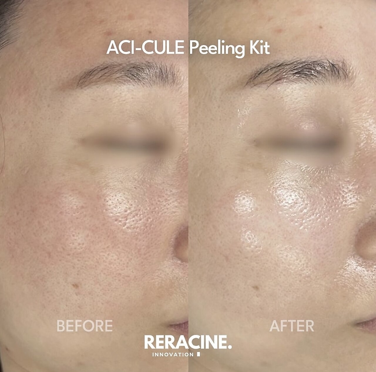 真岡市で毛穴洗浄・毛穴吸引が人気のエステサロン｜ホットペッパー