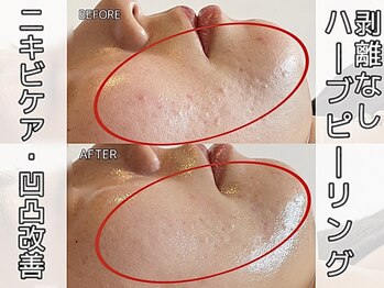 ヴィオール 名古屋栄店(VIOR)/剥離無し　ニキビケア　肌質改善