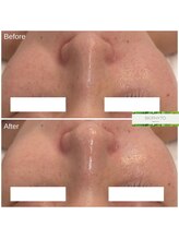 クレア(Clair)/ビオフィート症例