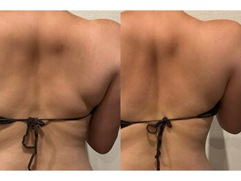 ユー 喜連西店(U)/脂肪冷却【before after】