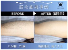 メンズビービー 福井高柳店(MEN'S BB)/ボディ脱毛施術事例