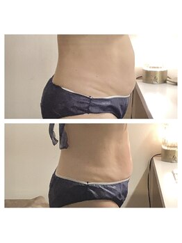 アクア エステティコ 亀有(ACQUA estetico)/脂肪燃焼 腹部 50代 3ヶ月経過