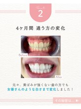 エクシアホワイトニング 阪急洛西口駅前店/継続で白い歯へ