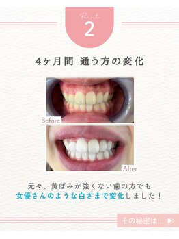 エクシアホワイトニング 阪急洛西口駅前店/継続で白い歯へ