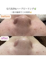 サクラ(SAKURA)/毛穴洗浄◎