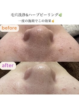 サクラ(SAKURA)/毛穴洗浄◎