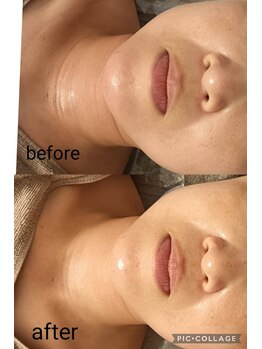 リープ(Lieb)/小顔幹細胞フェイシャル