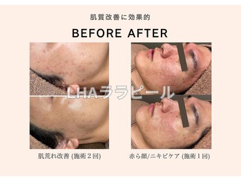 リジュベネーションサロン アリス(Alice)/ララピールB&A