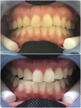 ハモットホワイト(Hamotto White)/照射1日目☆