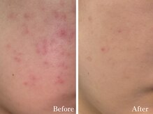 ラティエ(Latier)/肌トラブル改善♪予防にも◎