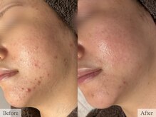 ティアラッシュ(TiaLash)/HAAB REPRO