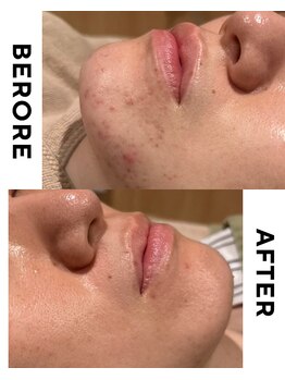 ミルキー(MiLuKy)の写真/お肌のトラブルにあわせて、ハーブピーリングでつるんとなめらかな美肌を体験◎