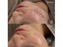 サロンドシェフィア(Salon de Chefia)/30代前半女性 症例写真