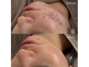 サロンドシェフィア(Salon de Chefia)/30代前半女性 症例写真