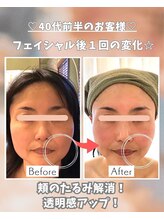 エステサロン 凛/お顔のもたつきがなくなりました