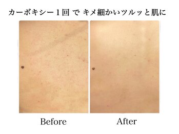 ナチュラーレ 天王寺店(Naturale)/美肌ニキビケア背中ブライダル