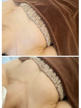 美人バスト 赤羽店/【バストアップ症例】