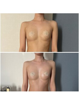 モア(moa)/ハリが出た