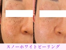 オーシャンブルー 大分店(OCEAN BLUE)/スノーホワイトピーリング