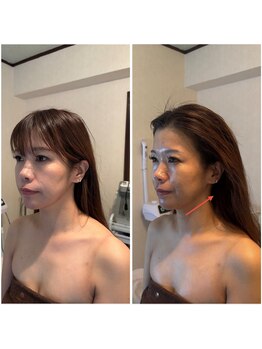 にっこりビューティー/★EMSマッサージ+エアバリ