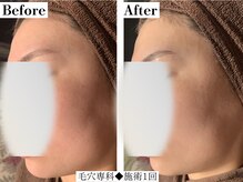 フレイヤ(FREYA)/毛穴専科Before→After