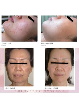 ルルアス 銀座(LuLuAS)/韓国発祥のムルトクスピール