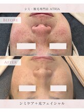 アトリア(ATRIA)/ホワイトシミケ×光フェイシャル