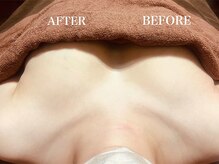 青空 チクシノサロン(SORA CHIKUSHINO SALON)/光豊胸＋背中＆二の腕ケア#5