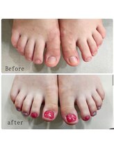 ティアラネイル 宇都宮/深爪矯正