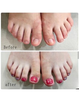 ティアラネイル 宇都宮/深爪矯正