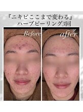 サロンドビジュー(salon de bijou)/ニキビケア×ハーブピーリング