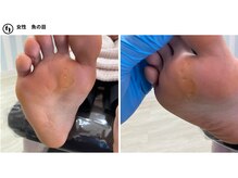 ふっとけ庵/タコ魚の目ケア
