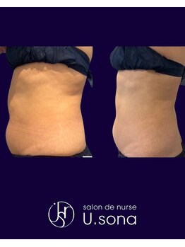 サロン ド ナース ユーソナ 松本店(salon de nurse U.sona)の写真/【信越エリア初◆全国認定サロンで究極痩身】看護師施術×ハイレベルマシン×刺さない脂肪分解注入