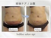 アピ(api)/症例写真【インディバ】